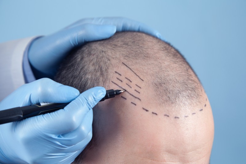Hair Transplant